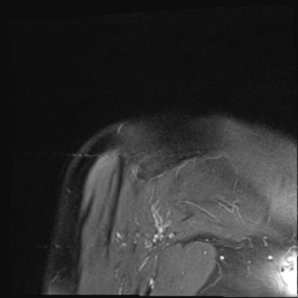 File:Avulsion fracture - greater tuberosity of humerus (Radiopaedia 71216-81515 Coronal PD fat sat 2).jpg