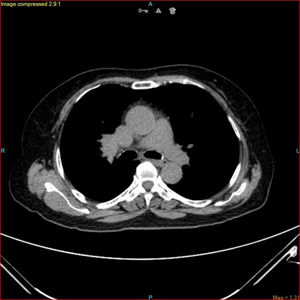 File:Azygos vein aneurysm (Radiopaedia 77824-90130 A 27).jpg