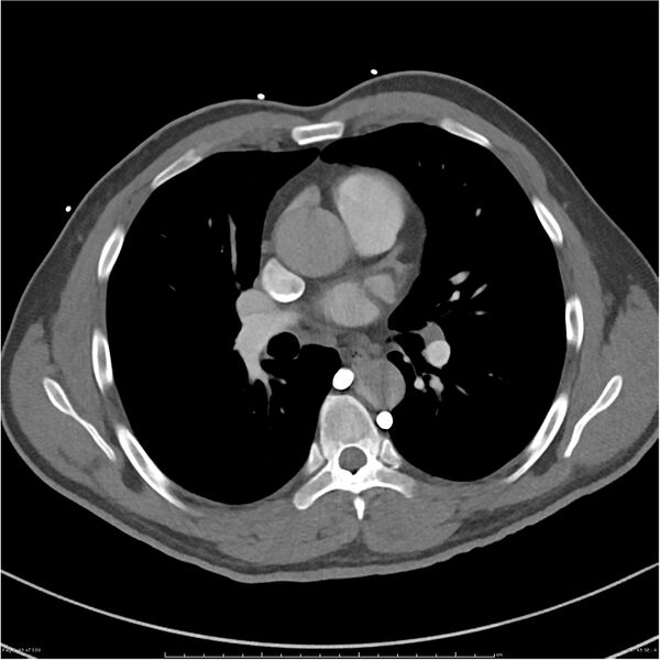 File:Azygos venous system anatomy (CT pulmonary angiography) (Radiopaedia 25928-26077 Axial C+ CTPA 43).jpg