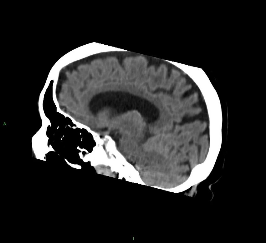 Basal ganglia hemorrhage (Radiopaedia 58762-65984 B 31).jpg