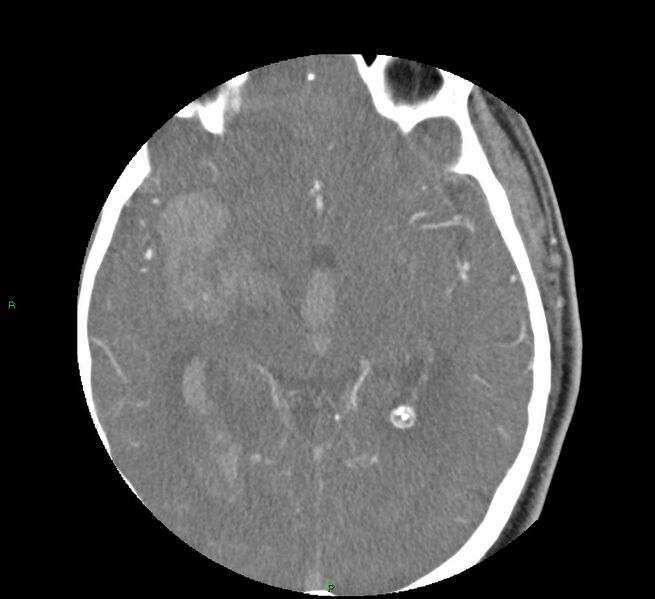 File:Basal ganglia hemorrhage (Radiopaedia 58763-65985 D 88).jpg