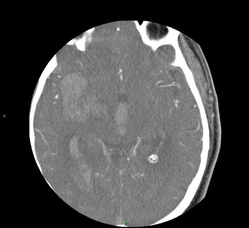 Basal ganglia hemorrhage (Radiopaedia 58763-65985 D 88).jpg