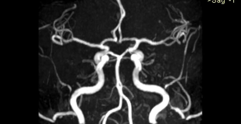 File:Basilar artery fenestration (Radiopaedia 74537-85455 3D TOF MIP MRA 3).jpg
