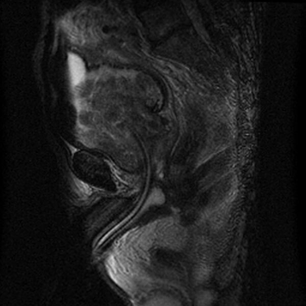 File:Benign prostatic hyperplasia (Radiopaedia 2586-6281 Sagittal T2 1).jpg