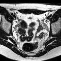 Bicornuate uterus (Radiopaedia 11104-11492 Axial T2 24).jpg