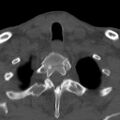 Bilateral C6-7 locked facet dislocation (Radiopaedia 28506-28748 Axial bone window 41).jpeg