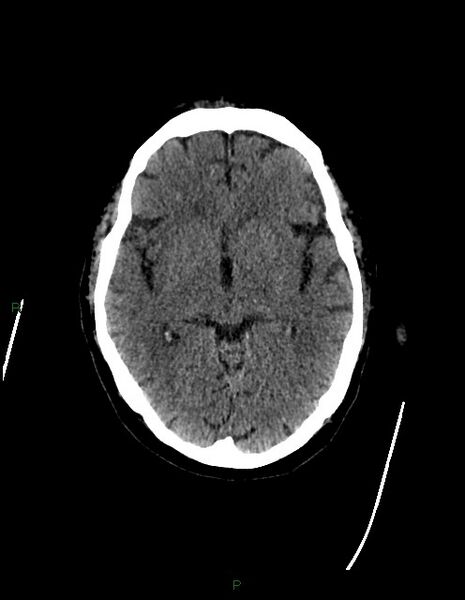 File:Bilateral acute middle cerebral artery territory infarcts (Radiopaedia 77319-89401 Axial non-contrast 39).jpg