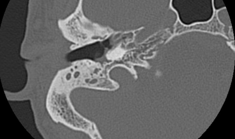 File:Bilateral cholesteatoma (Radiopaedia 54898-61172 Axial bone window 14).jpg