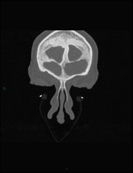 File:Bilateral frontal mucoceles (Radiopaedia 82352-96454 Coronal 49).jpg