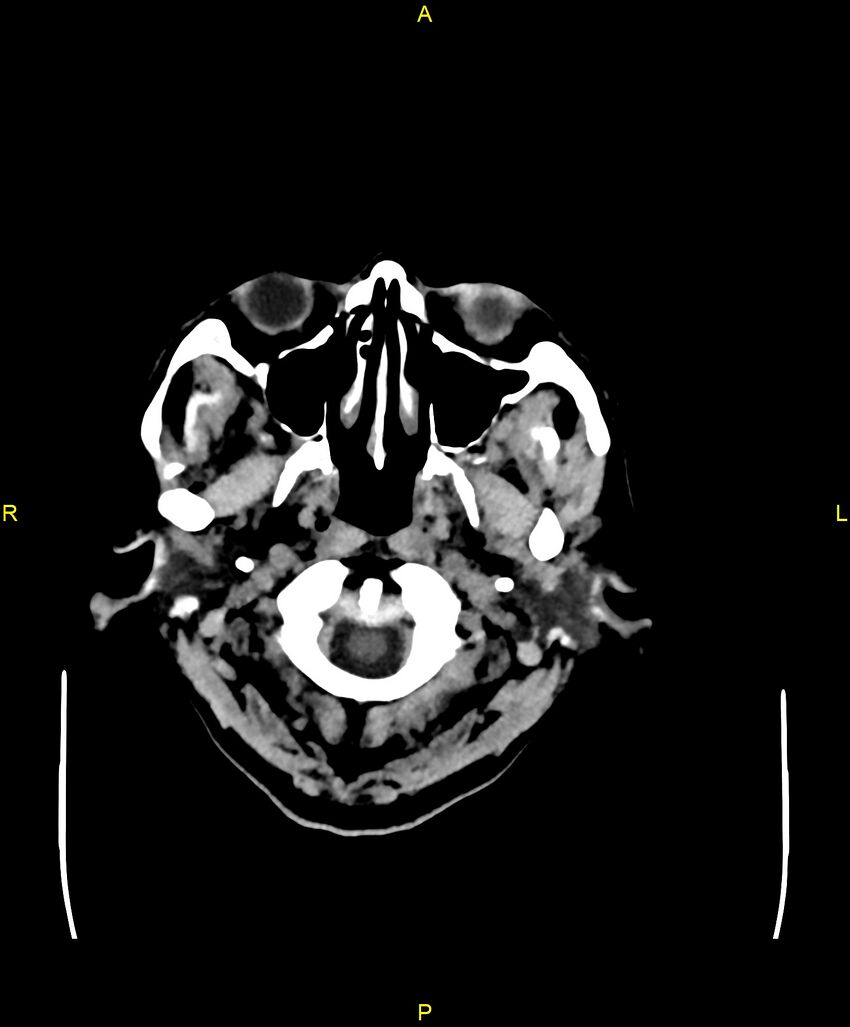 Bilateral isodense subdural hematomas (Radiopaedia 88621-105325 Axial non-contrast 1).jpg