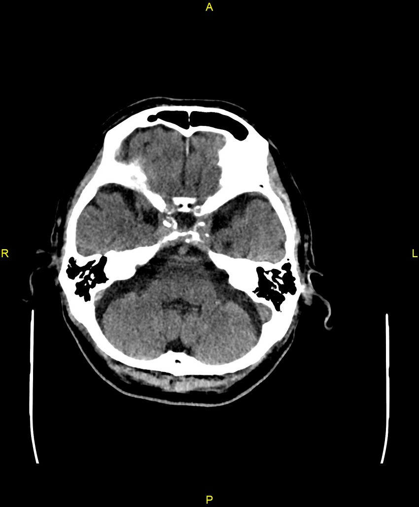 Bilateral isodense subdural hematomas (Radiopaedia 88621-105325 Axial non-contrast 25).jpg
