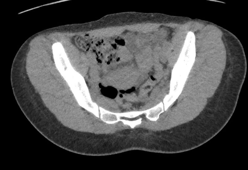 File:Bilateral mature cystic ovarian teratoma (Radiopaedia 88821-105592 Axial non-contrast 9).jpg
