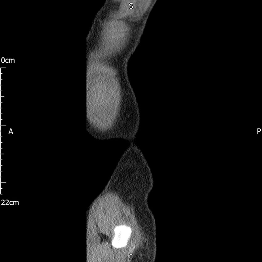 Bilateral medullary nephrocalcinosis with ureteric calculi (Radiopaedia 71269-81569 C 8).jpg