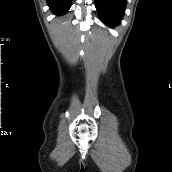 File:Bilateral medullary nephrocalcinosis with ureteric calculi (Radiopaedia 71269-81569 Coronal non-contrast 68).jpg