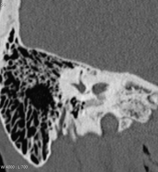File:Bilateral otosclerosis with left stapes prosthesis (Radiopaedia 5567-7302 Coronal bone window 15).jpg