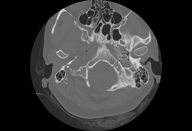 File:Bilateral otospongiosis (Radiopaedia 35447-36940 Axial bone window 6).jpg