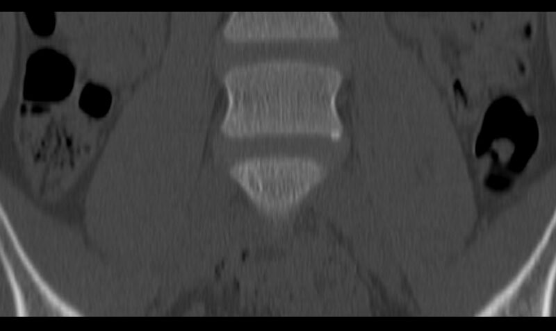File:Bilateral pars defect (Radiopaedia 26691-26846 Coronal bone window 10).jpg