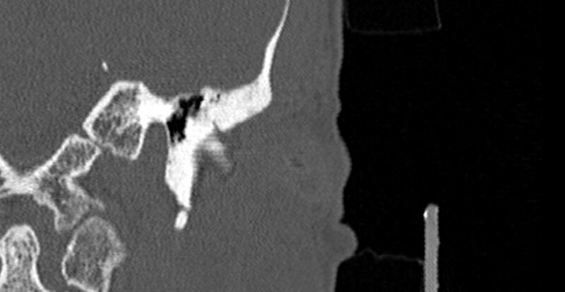 File:Bilateral temporal bone fractures (Radiopaedia 29482-29970 B 8).jpg