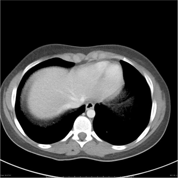 File:Bilateral ureteritis and cystitis (Radiopaedia 25340-25594 A 5).jpg