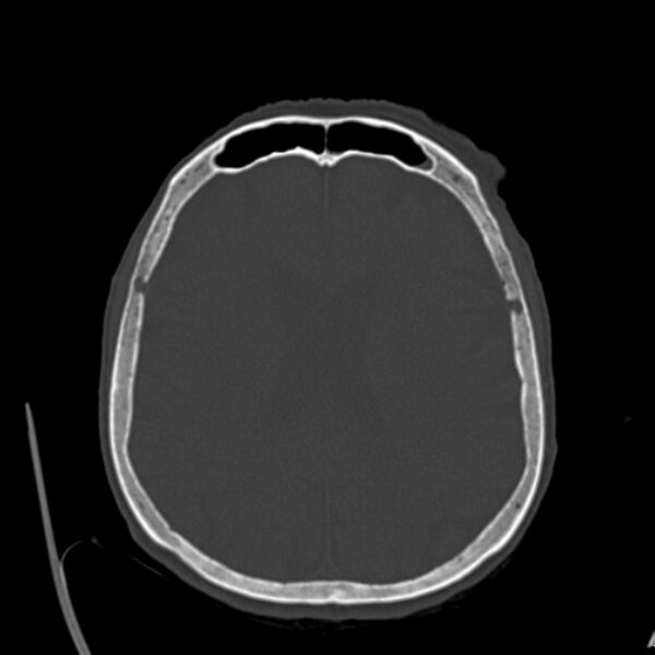 File:Biparietal osteodystrophy (Radiopaedia 46109-50463 bone window 42).jpg