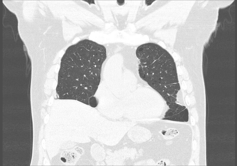 File:Birt-Hogg-Dubé syndrome (Radiopaedia 52578-58491 Coronal lung window 13).jpg