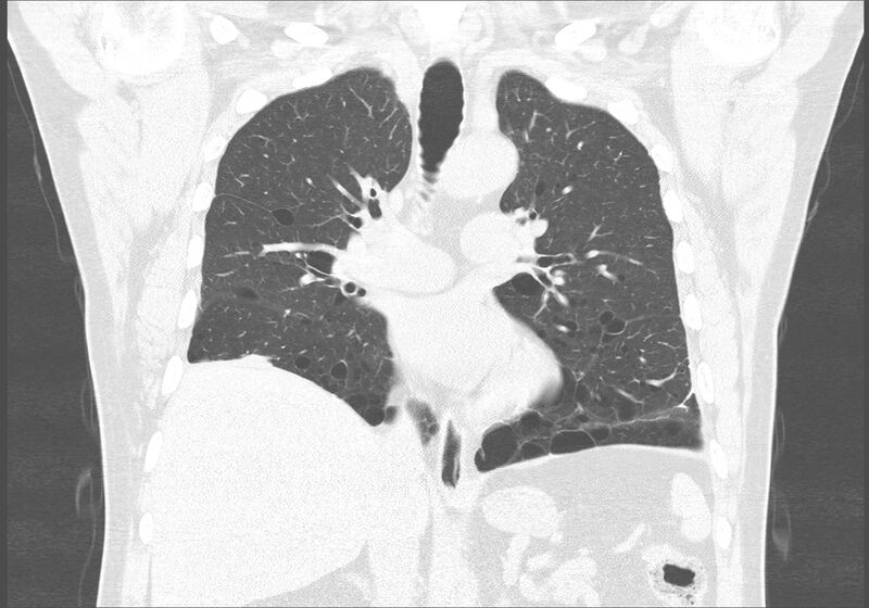 File:Birt-Hogg-Dubé syndrome (Radiopaedia 52578-58491 Coronal lung window 28).jpg