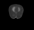 Bladder papillary urothelial carcinoma (Radiopaedia 48119-52951 C 2).png