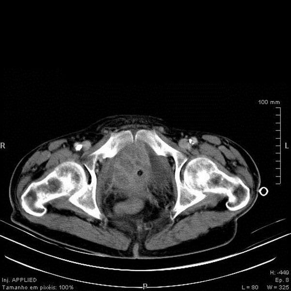 File:Bladder squamous cell carcinoma (Radiopaedia 14130-13984 B 12).jpg