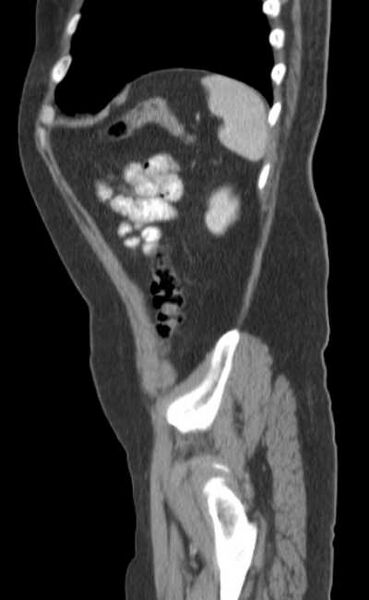 File:Bleeding duodenal ulcer and adenomyomatosis of gallbladder (Radiopaedia 61834-69861 C 87).jpg