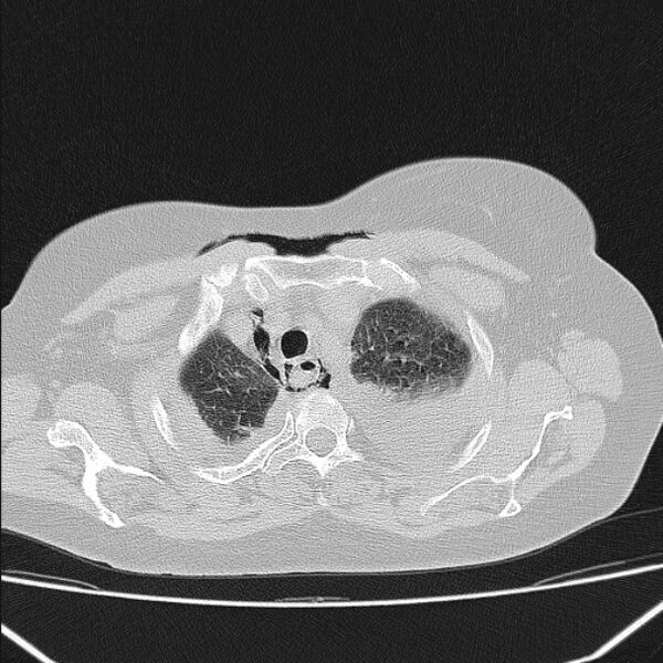 File:Boerhaave syndrome (Radiopaedia 45644-49799 Axial lung window 38).jpg