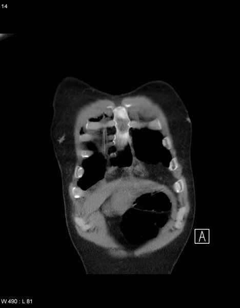 File:Boerhaave syndrome with tension pneumothorax (Radiopaedia 56794-63605 B 2).jpg