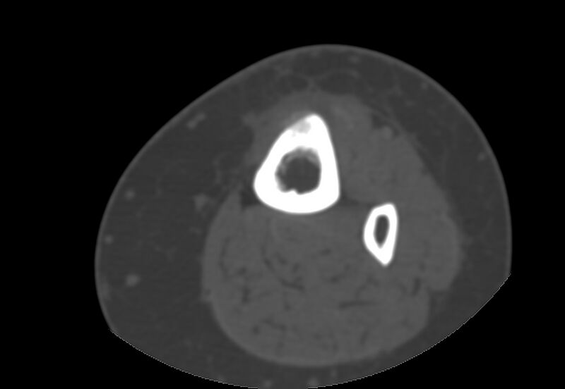 File:Bone metastasis - tibia (Radiopaedia 57665-64609 Axial bone window 22).jpg