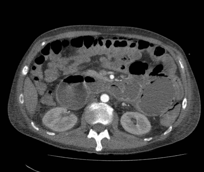 File:Bowel lymphoma complicated by bleeding after therapy (Radiopaedia 55601-62110 B 33).jpg