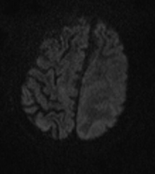 File:Brain abscess with dual rim sign (Radiopaedia 87566-103938 Axial DWI 16).jpg