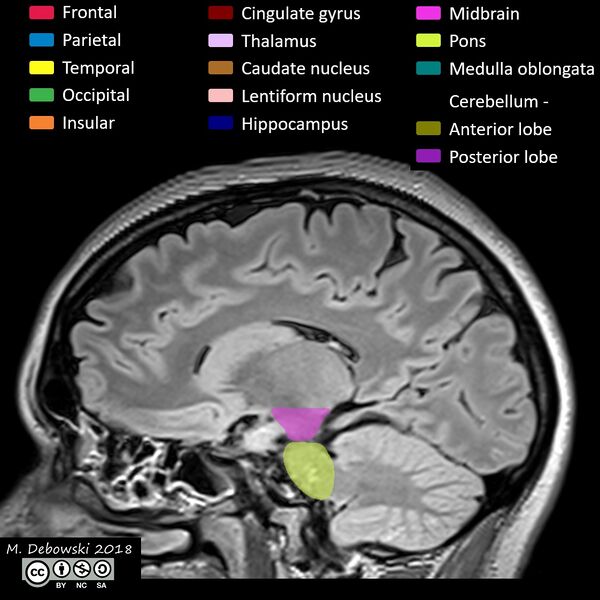 File:Brain lobes - annotated MRI (Radiopaedia 61691-69700 Sagittal 32).JPG