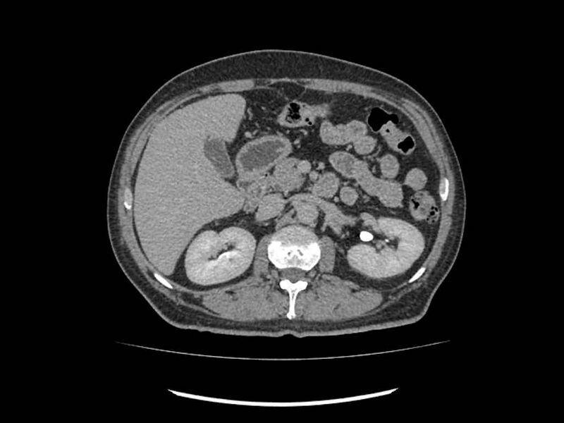 File:Brain metastases from renal cell carcinoma (Radiopaedia 42222-45328 Axial C+ delayed 75).jpg
