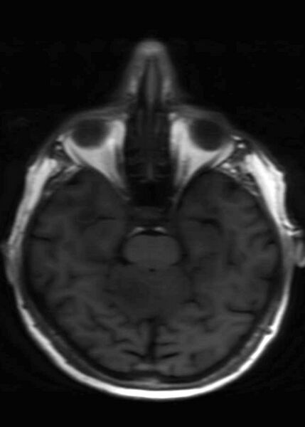 File:Brain metastases from squamocellular lung cancer (Radiopaedia 56515-63222 Axial T1 10).jpg