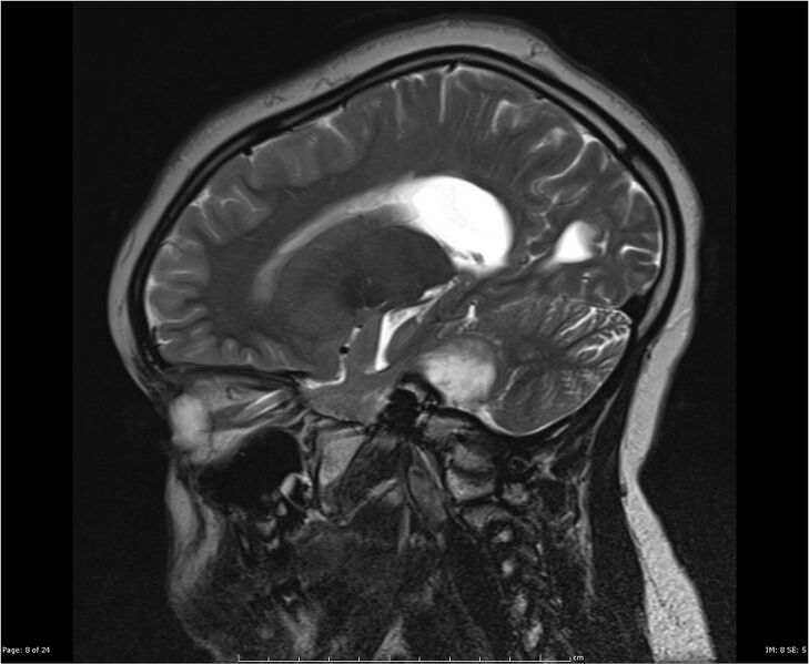 File:Brainstem glioma (Radiopaedia 21819-21775 Sagittal T2 8).jpg
