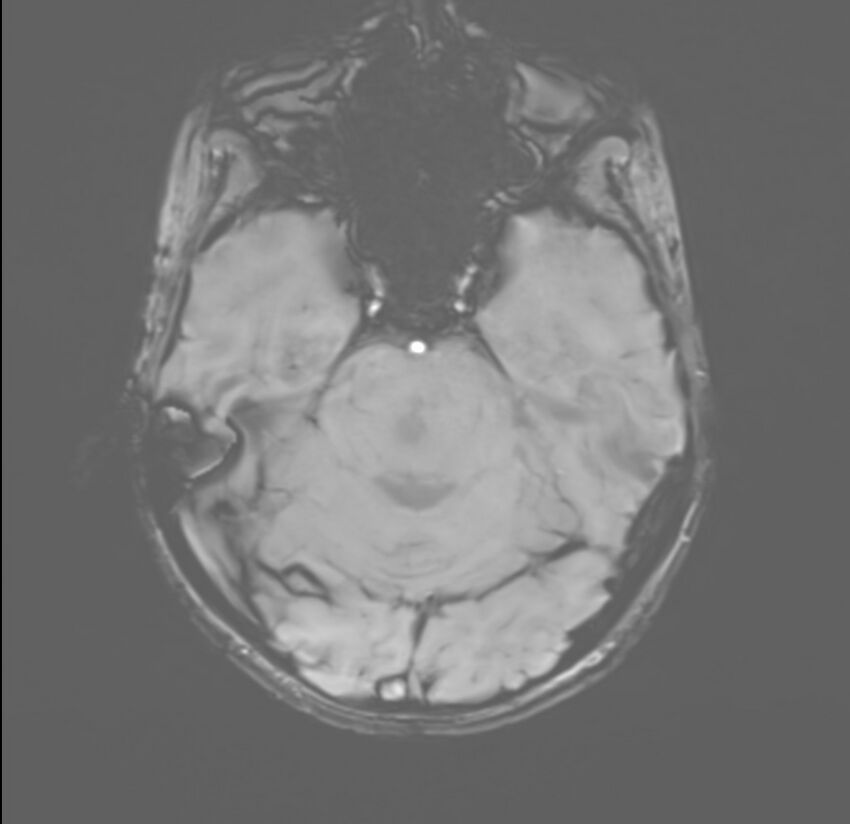 Brainstem glioma (Radiopaedia 70548-80674 Axial SWI 16).jpg