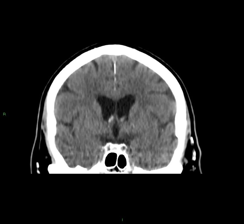 Brainstem hemorrhage (Radiopaedia 58794-66028 Coronal non-contrast 38).jpg