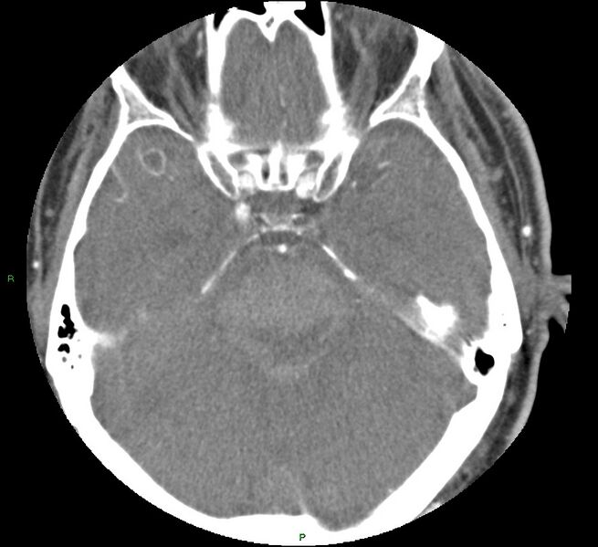 File:Brainstem hemorrhage (Radiopaedia 58794-66028 D 66).jpg