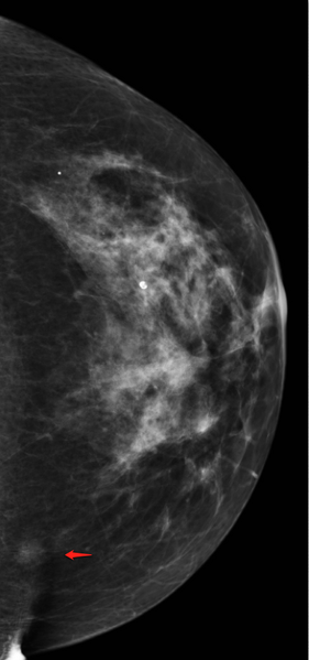 File:Breast asymmetry - interpretation pitfall (Radiopaedia 21654-21615 CC 1).png