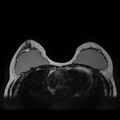 Breast implants - MRI (Radiopaedia 26864-27035 Axial T2 21).jpg