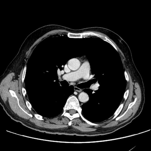 File:Bronchogenic carcinoma with L1 vertebra metastasis (Radiopaedia 9096-9805 Axial C+ delayed 14).jpg