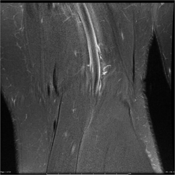File:Bucket handle tear - lateral meniscus (Radiopaedia 7246-8187 Coronal T2 fat sat 1).jpg