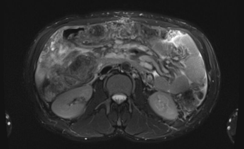 File:Budd Chiari syndrome (Radiopaedia 70299-80375 Axial T2 fat sat 27).jpg
