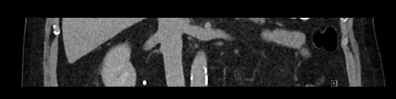 File:Buried bumper syndrome - gastrostomy tube (Radiopaedia 63843-72575 Coronal 10).jpg