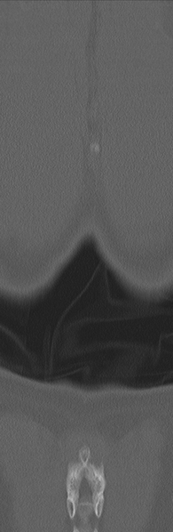 File:Burst fracture - T12 with conus compression (Radiopaedia 56825-63647 Coronal bone window 41).png