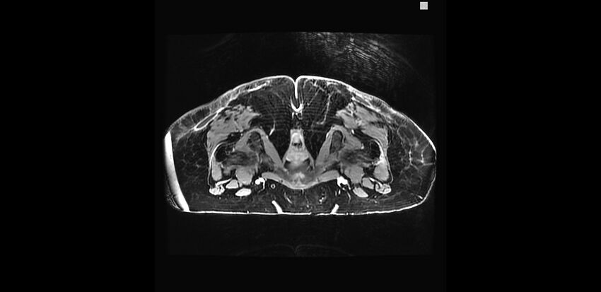 Buttock filler complications (Radiopaedia 63497-72115 Axial T1 C+ 40).jpg