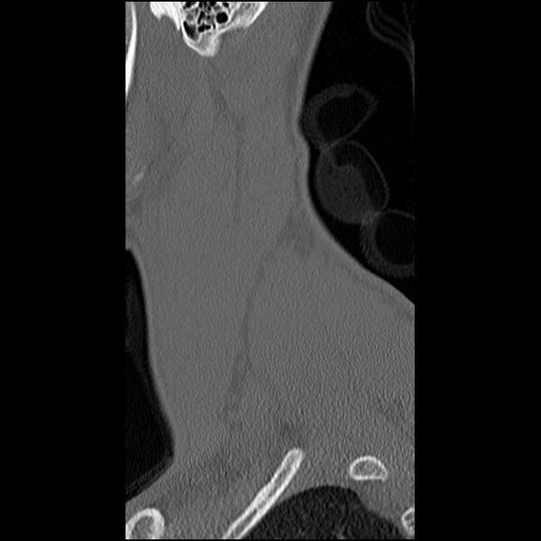 File:C5 facet fracture (Radiopaedia 58374-65499 Sagittal bone window 64).jpg